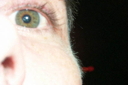 todd's fat eye